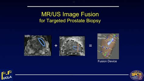 MRI/US Fusion Prostate Biopsy | Leonard S. Marks, MD