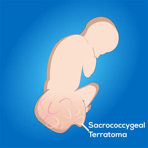 What are Teratomas? Pathophysiology, Types, Symptoms, Investigations & Treatments - Tiny Medicine