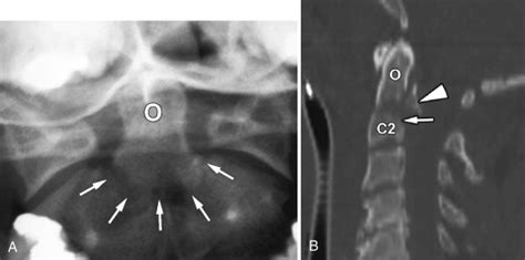 Hangman’s Fracture | Radiology Key