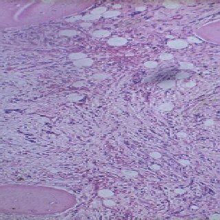 This slide shows a trephine biopsy specimen of idiopathic myelofibrosis... | Download Scientific ...