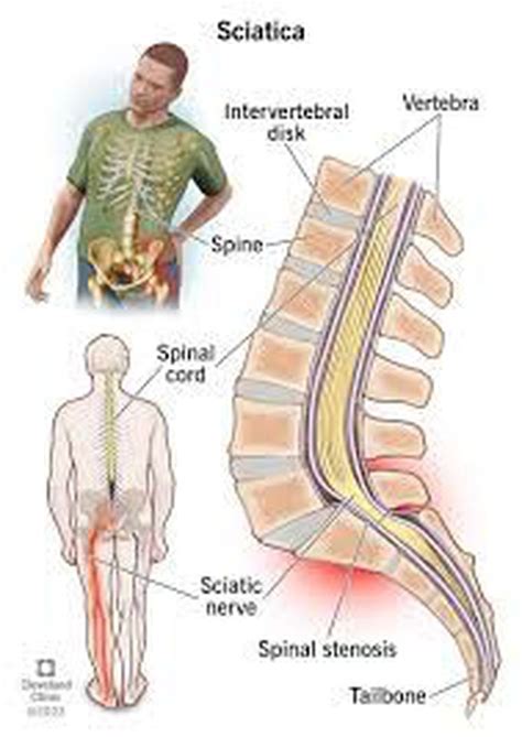 Treatment for sciatica - MEDizzy