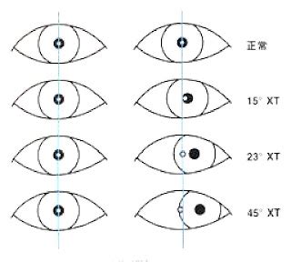 dewa-dony: strabismus