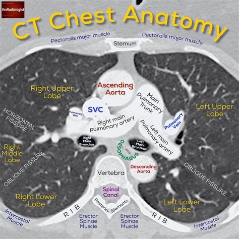 Swipe left for a recap on posts of CT chest anatomy...⁣ ⁣ ⁣ ⁣ Before ...