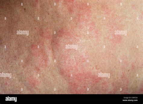 urticarial rash due to an allergic reaction to antibiotics Stock Photo ...