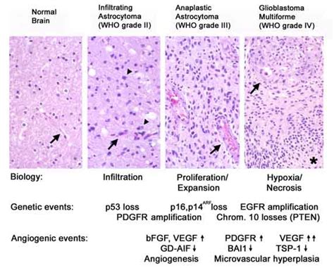 grade i astrocytoma – Liberal Dictionary