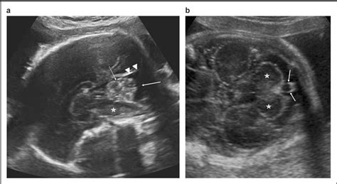 Figure 1 from The fetal cerebellum: development and common malformations. | Semantic Scholar