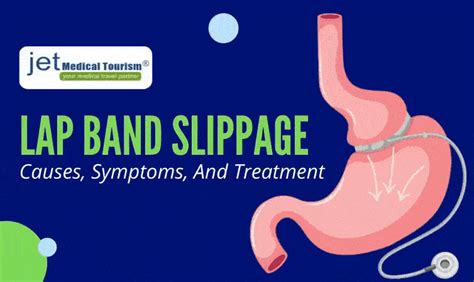 Lap Band Slippage: Causes, Symptoms, And Treatment