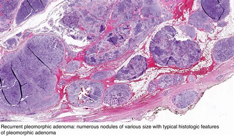 Pathology Outlines - Pleomorphic adenoma