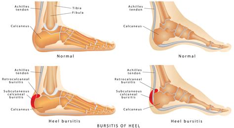 What is Bursitis of Heel? Shuman Podiatry & Sports Medicine - Foot Care