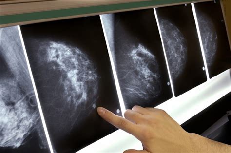 False_Positive_False_Negative_Mammogram | Berkeley Institute International