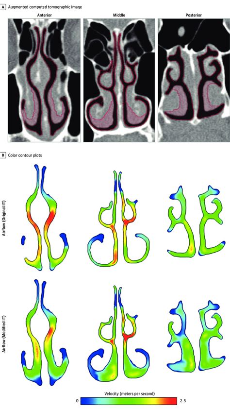 Virtual Inferior Turbinate Reduction | Download Scientific Diagram