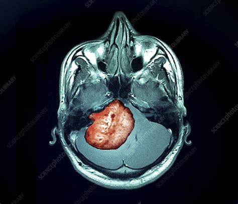 Acoustic neuroma tumour, MRI scan - Stock Image - C048/9197 - Science ...