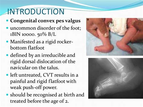 Congenital vertical talus UG lecture