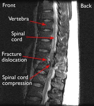 Anterior Wedging Of Vertebral Bodies - tiktoktoktok