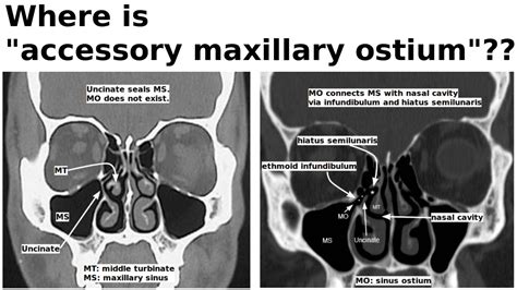 Ostium Of Maxillary Sinus