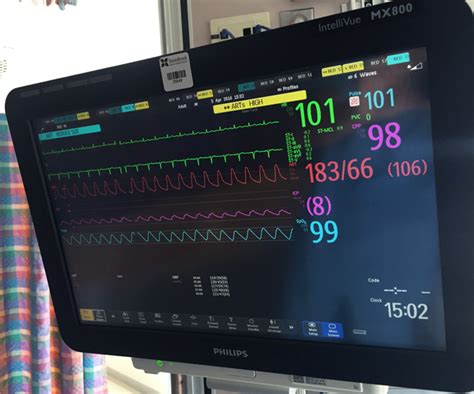 Ecg heart monitor - tiklosite