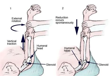 What is shoulder reduction – NSPDD