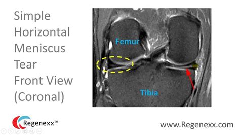 How to Read a Knee MRI for Meniscus Tears | Doovi