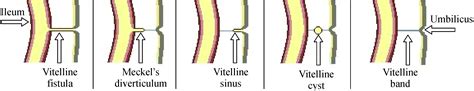 Development of midgut and hindgut | DentMistry