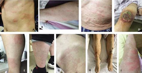 Urticarial rash in NLRP3-AID (A), NLRP12-AID (B) and Schnitzler... | Download Scientific Diagram