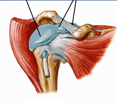 Subdeltoid Bursitis