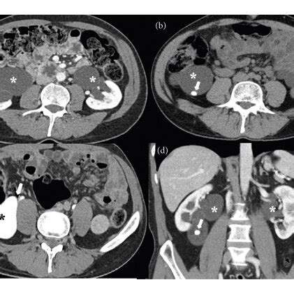 (a) The nephrogram phase of the contrast enhanced CT scan shows severe ...