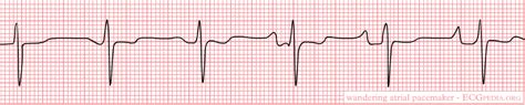 Wandering atrial pacemaker - wikidoc