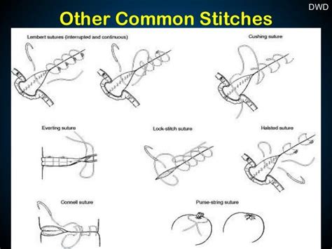 How Many Types Of Stitches In Surgery - Patricia Sinclair's Coloring Pages