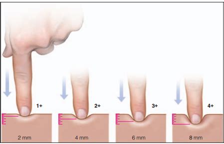 Scale for pitting edema