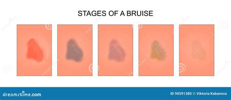 Bruise Color Progression Chart