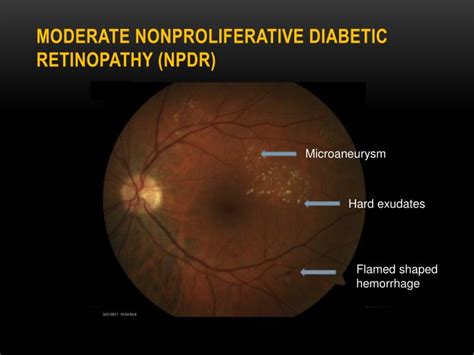 PPT - DIABETIC RETINOPATHY PowerPoint Presentation - ID:788556