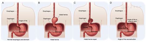 Effect of laparoscopic angle of His reconstruction in the treatment of patients with ...