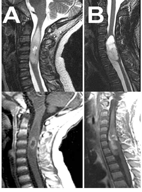 Detection of spinal cord tumor-related edema on MRI. Examples of the... | Download Scientific ...