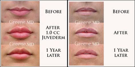 Lip Augmentation 1 Year Later Results Dr. Ryan Greene | Lip augmentation, Lip fillers juvederm ...