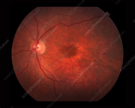 Bull's Eye Maculopathy - Stock Image - C027/1308 - Science Photo Library