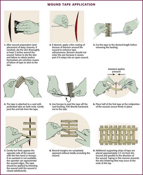 Methods of Wound Closure | Veterian Key