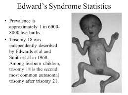 Trisomy 18 known as Edwards Syndrome | Strive For Good Health