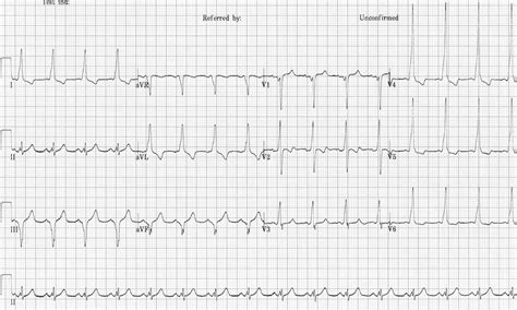 Pre-excitation syndromes • LITFL • ECG Library Diagnosis