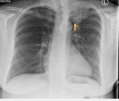 Chest x-ray showing opacification of left lung apex with slightly ...