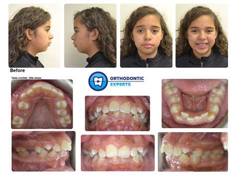 2.Bite ramps | Top Orthodontist: Braces, Invisalign