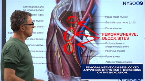 Knee Nerve Block Procedure