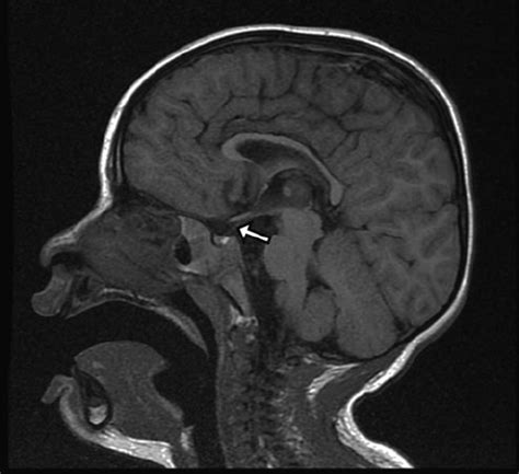 Sagittal T1-weighted MRI of a patient with a postfixed chiasm and... | Download Scientific Diagram