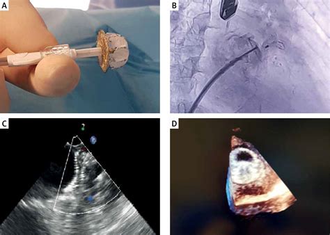 Left Atrial Appendage Closure Device