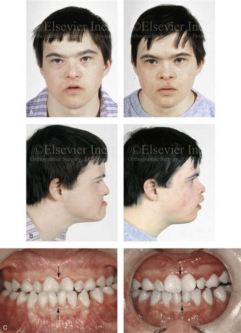 31: Selected Complex Malformations that Frequently Require Maxillofacial Reconstruction ...