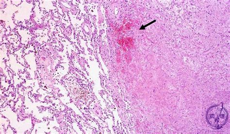 5.Lung, Pleura (2) Hemorrhagic infarct of lung|Pathology Core Pictures