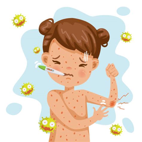 Measles Illustrations, Royalty-Free Vector Graphics & Clip Art - iStock