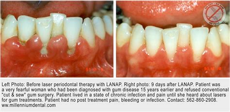 Healthy Teeth - Amazing Smiles: San Antonio Patients With Gum Disease Have Effective Treatment ...