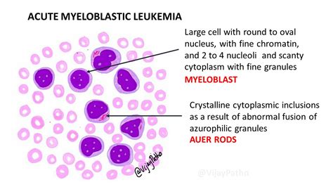 Peripheral smear findings in Leukemia – Illustrated | Pathology Made Simple