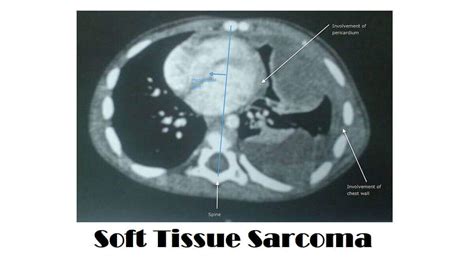 Soft Tissue Sarcoma: 7 Types, Causes, Symptoms, And Diagnosis