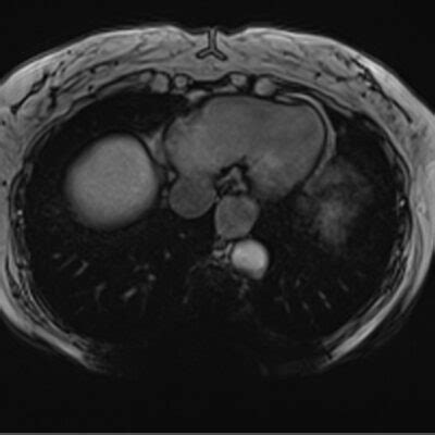 Metal \Titanium Artifact MRI | Magnetic Susceptibility Artifact MRI